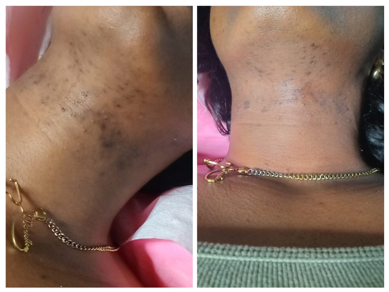 Before and after neck hyperpigmentation and bump treatment