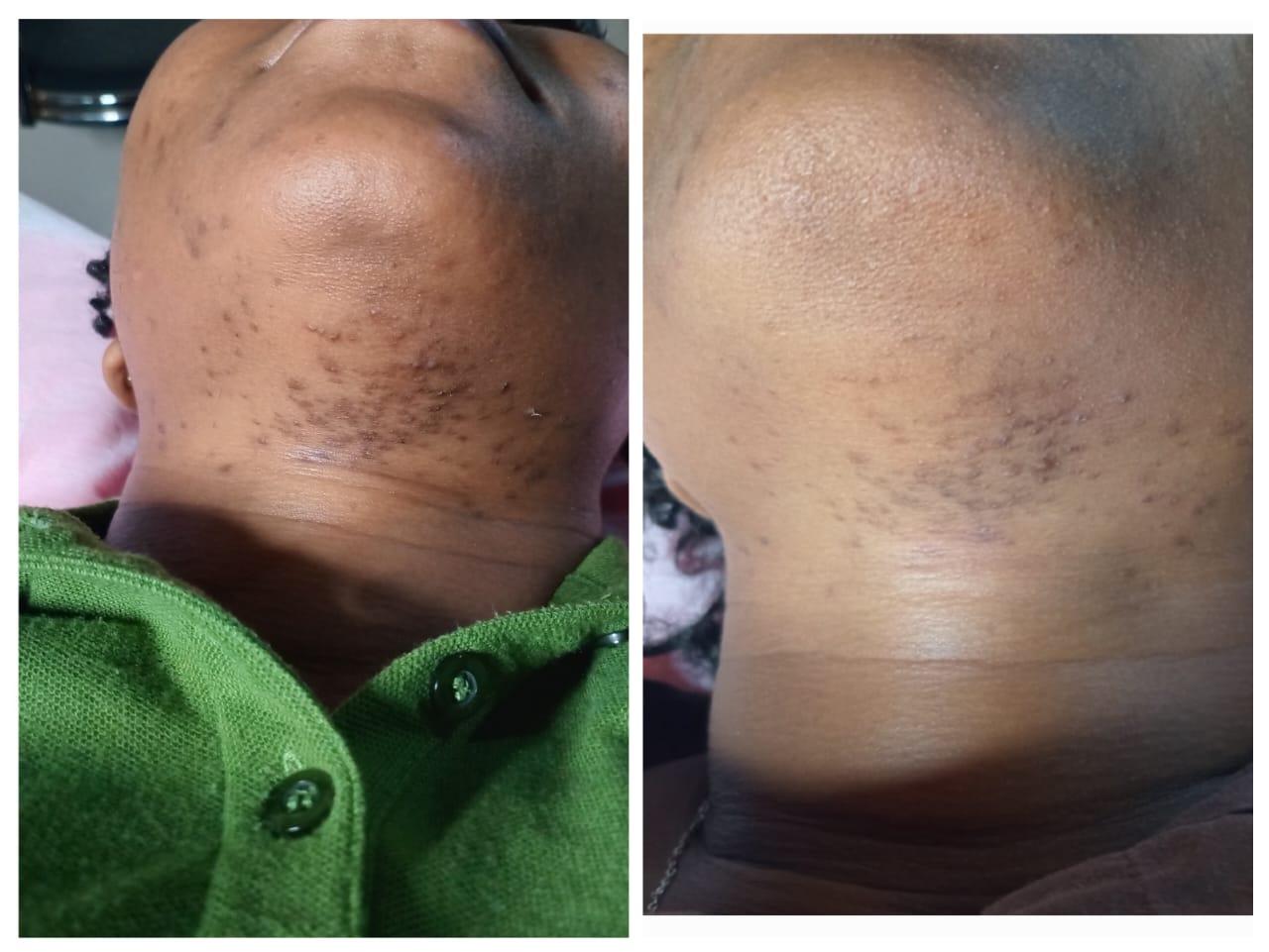 Before and after neck ingrown hair and bump treatment